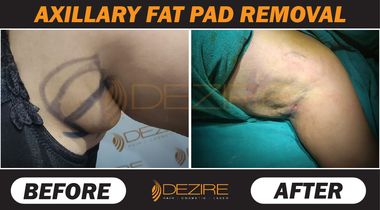 Liposuction Before After Photo Gallery
