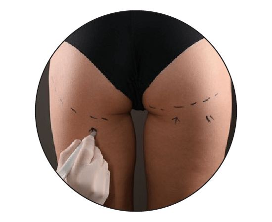 Buttock Augmentation Surgery in Delhi