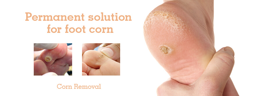 Corn removal hot sale finger