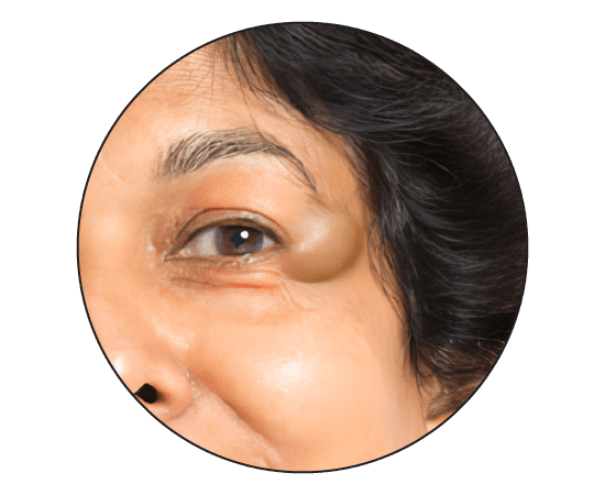 dermoid cyst on face