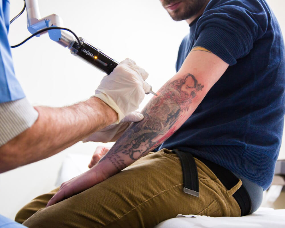 Pico Laser: How Many Sessions to Remove a Tattoo?