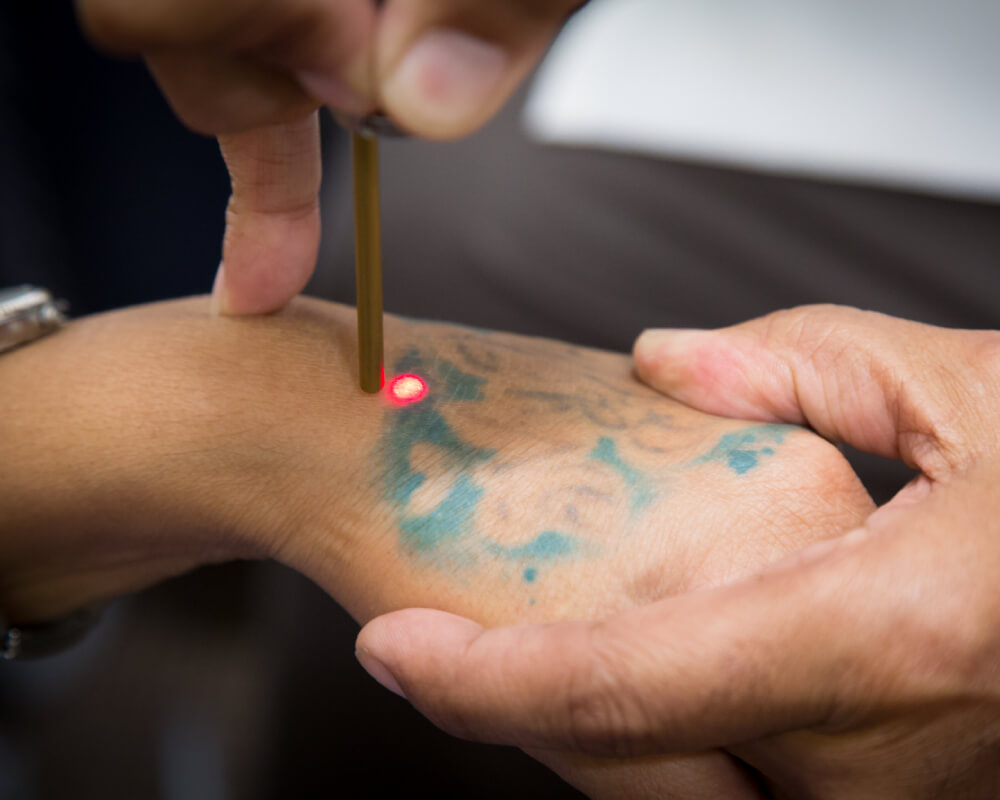 Tattoo removal cost - How much does it cost to remove a tattoo? - 207 Laser  & Integrative MED