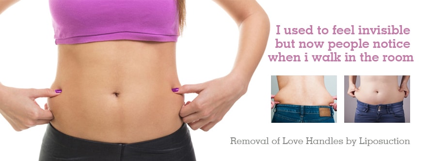 Is liposuction efficient against love handles ?