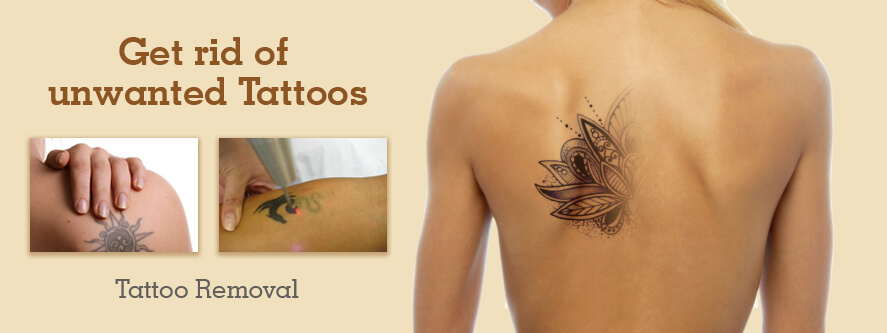 Details of Tattoo Removal Types You Ought to Know
