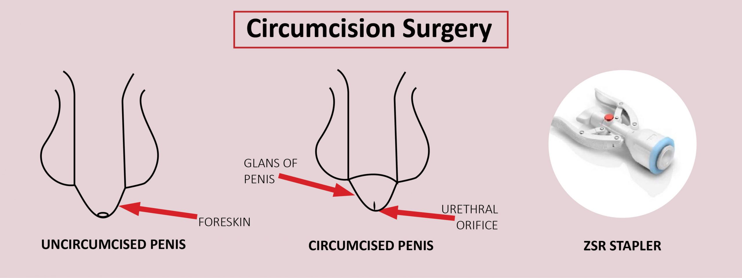 Best Treatment for Phimosis  Circumcision Doctor in Udaipur