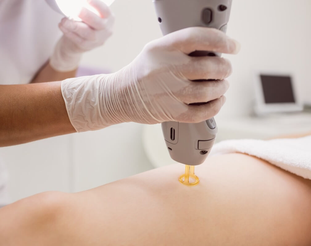 Permanent Laser Hair Removal for Female in Gurgaon Dezire Clinic