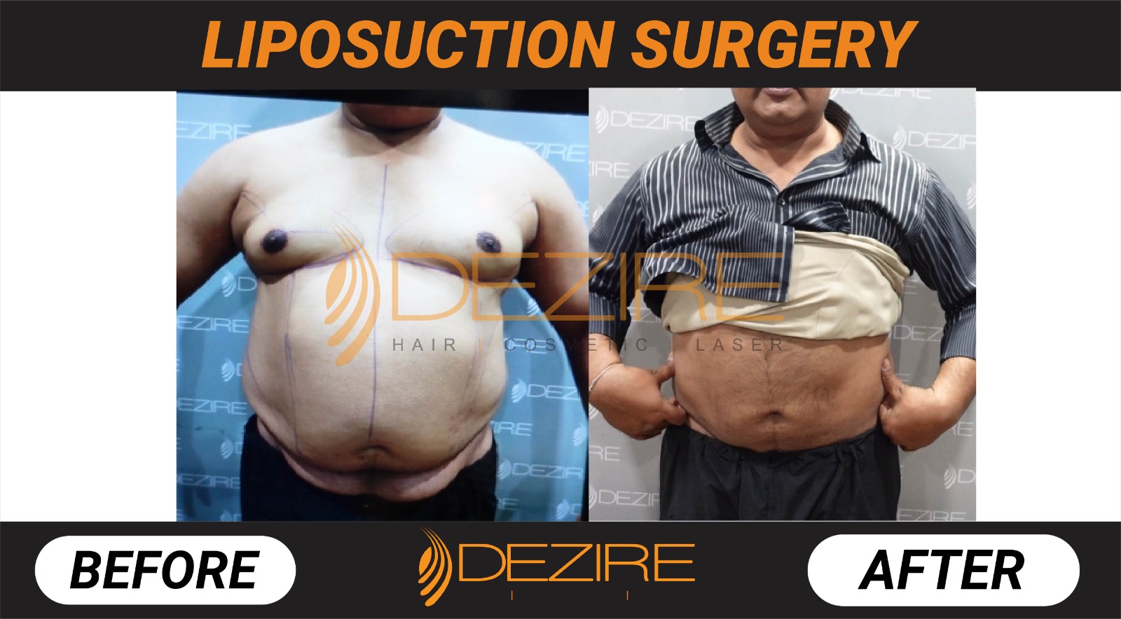 Liposuction Before After Photo Gallery