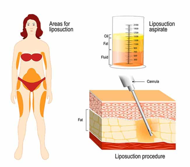 vaser liposuction